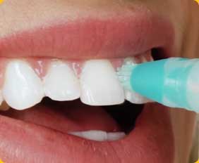 Tẩy trắng răng