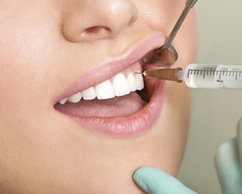 Điều trị cười hở lợi